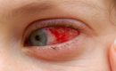 Saiba mais sobre a Esclerite! Uma doença que atinge a parte branca dos seus olhos