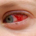 Saiba mais sobre a Esclerite! Uma doença que atinge a parte branca dos seus olhos