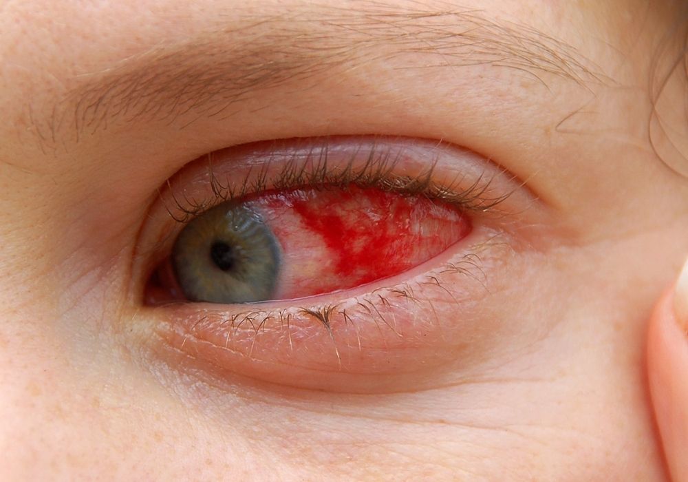 Saiba mais sobre a Esclerite! Uma doença que atinge a parte branca dos seus olhos