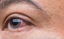 glaucoma
