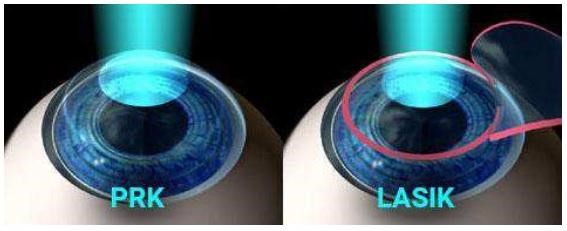 Cirurgia Refrativa a laser