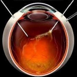 Cirurgia e Tratamento para Descolamento de Retina - COHR